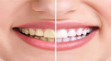 رابطه شگفت‌انگیز میان مزاج و رنگ دندان‌ها